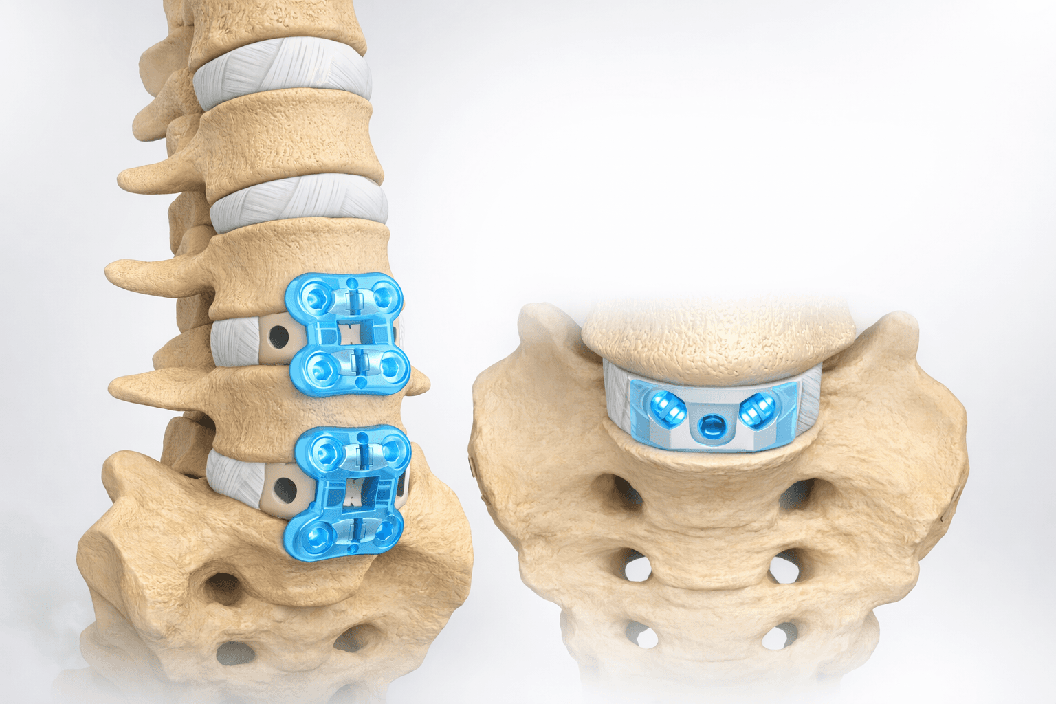 Expert orthopedic insights from Mountain Spine & Orthopedics - ALIF Surgery: Relieve Back Pain Without Cutting Back Muscles