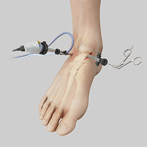Medical illustration of Ankle Arthroscopy treated by Mountain Spine & Orthopedics.
