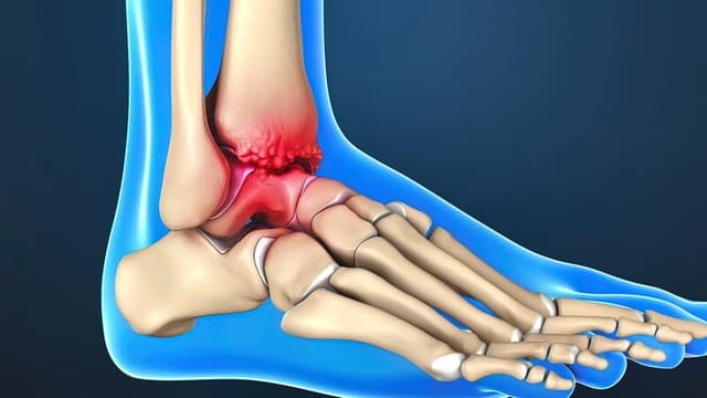 Medical illustration of Ankle Replacement treated by Mountain Spine & Orthopedics.