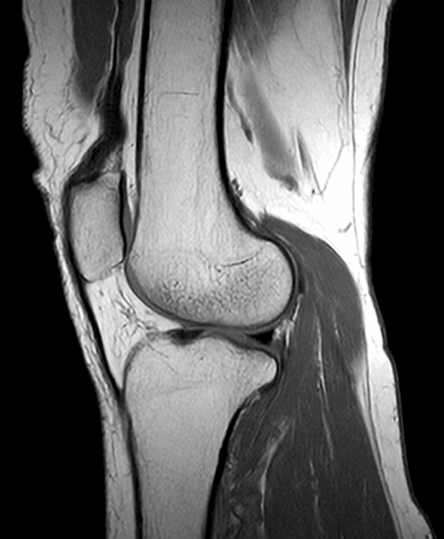 Image of an MRI Bone Scan
